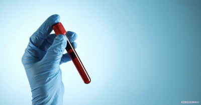 فحص دم بسيط قد يكشف خطر الإصابة بمرض ألزهايمر قبل سنوات من ظهور الأعراض