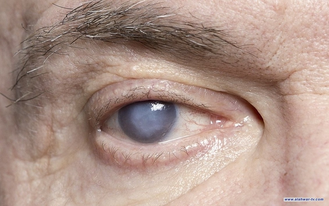 تأثير خفي لمرض السكري على صحة العين