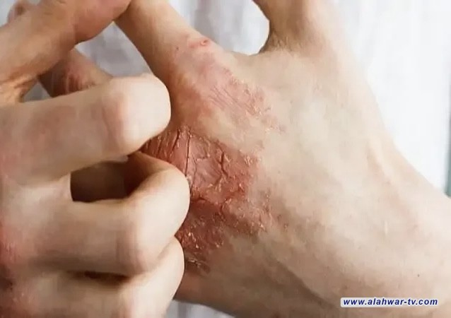 دراسة تكشف ارتباط الإكزيما بأمراض الكلى المزمنة