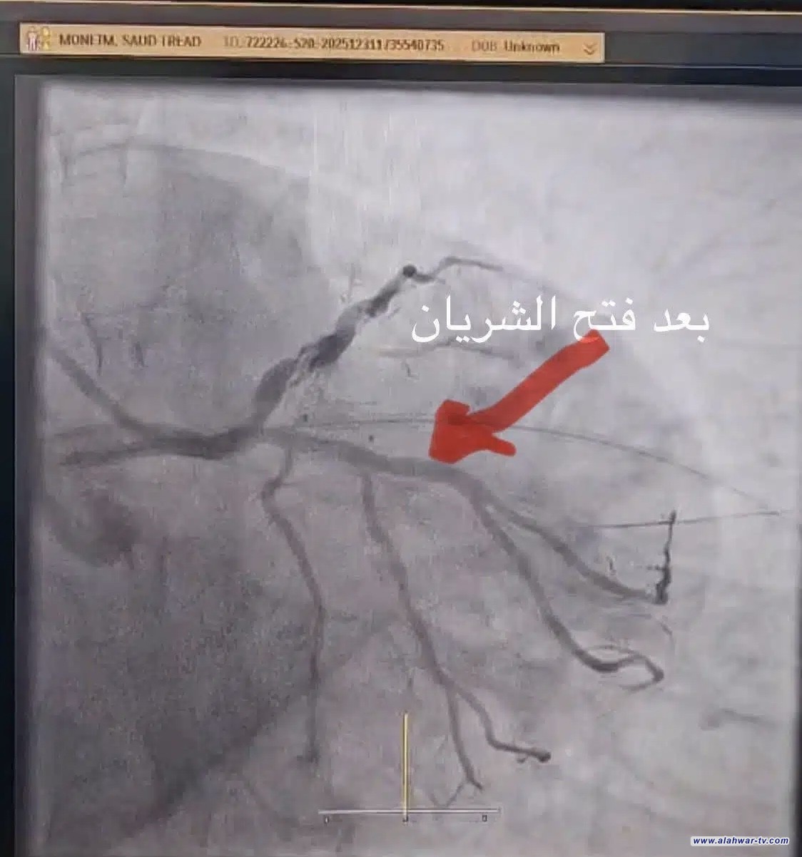 مع أولى ساعات 2026 قسطرة قلبية تنقذ ثلاثة مرضى من الموت في الناصرية