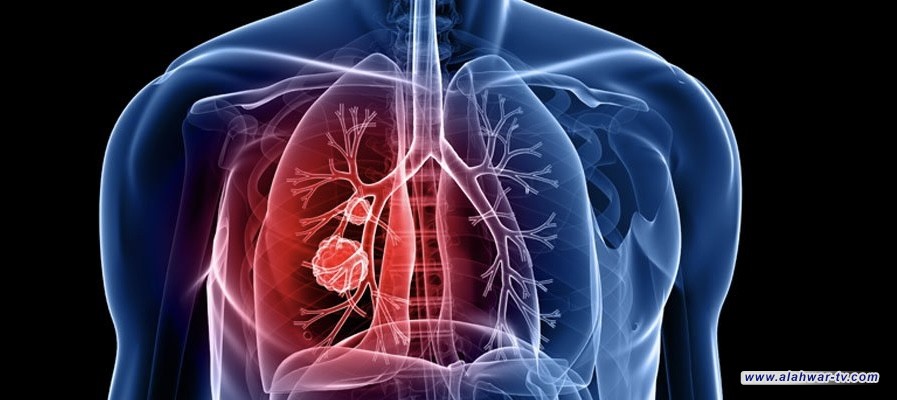 باحثون يكتشفون علاقة بين استهلاك أطعمة شائعة وسرطان الرئة