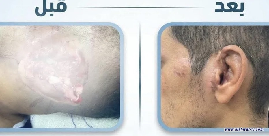 فريق طبي ينجح بإعادة أذن مبتورة لوضعها الطبيعي جنوبي العراق