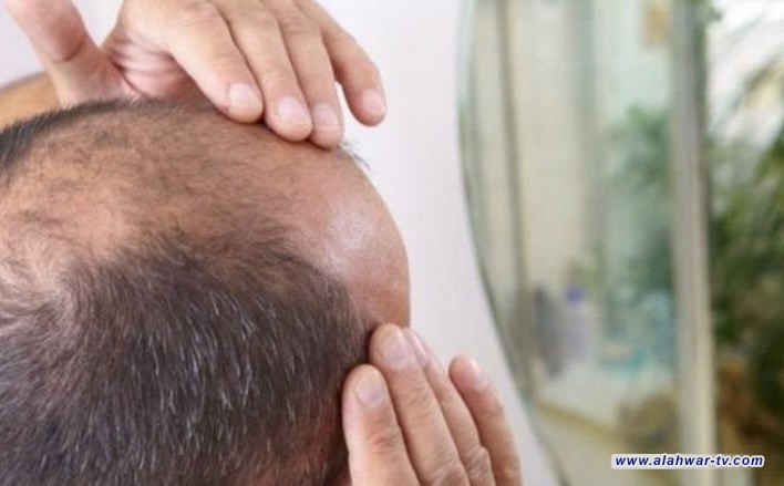اكتشاف علاج لتساقط الشعر الوراثي
