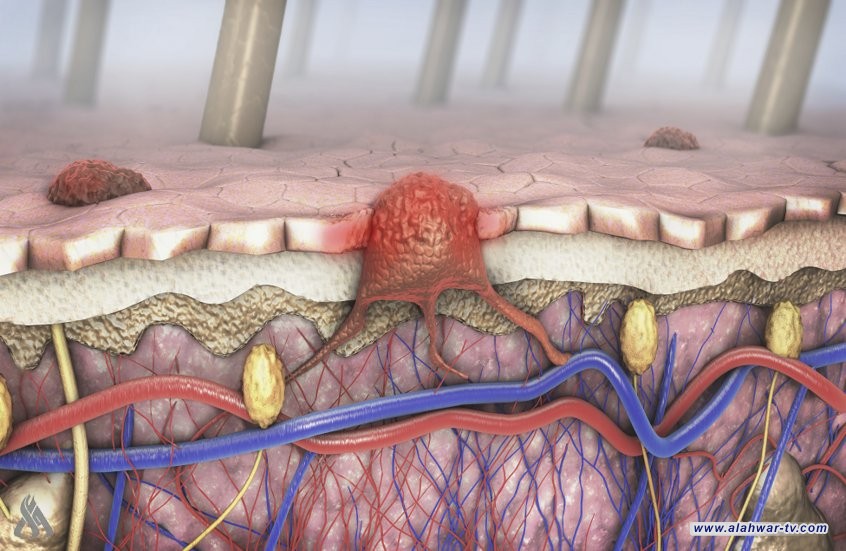 مكان غير متوقع قد يظهر فيه سرطان الجلد الميلانيني