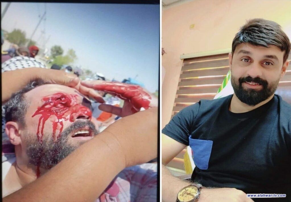 بالصورة: متظاهر كاد ان يفقد عينه في قمع غير مبرر لمظاهرة تطالب بتثبيت المتعاقدين