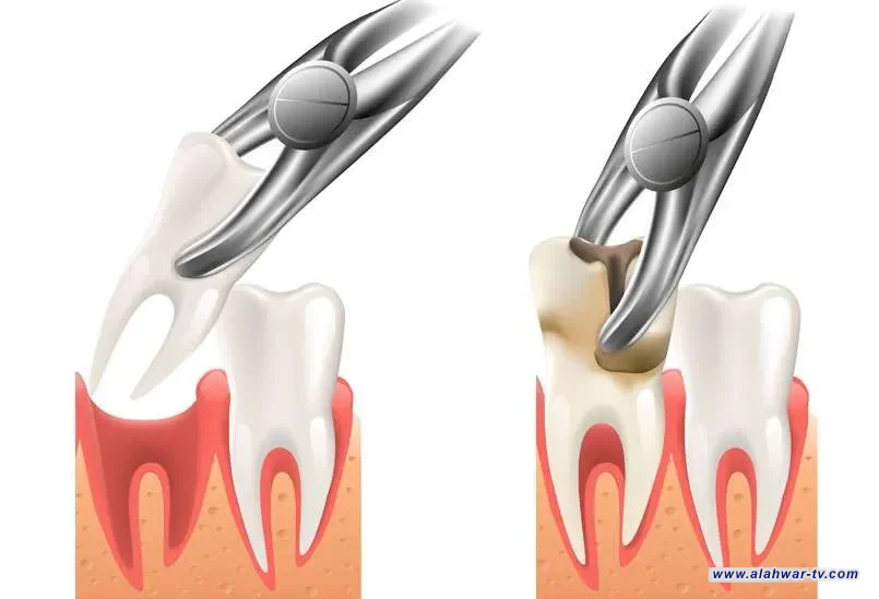 مختصة تحدد حالات قلع أضراس العقل