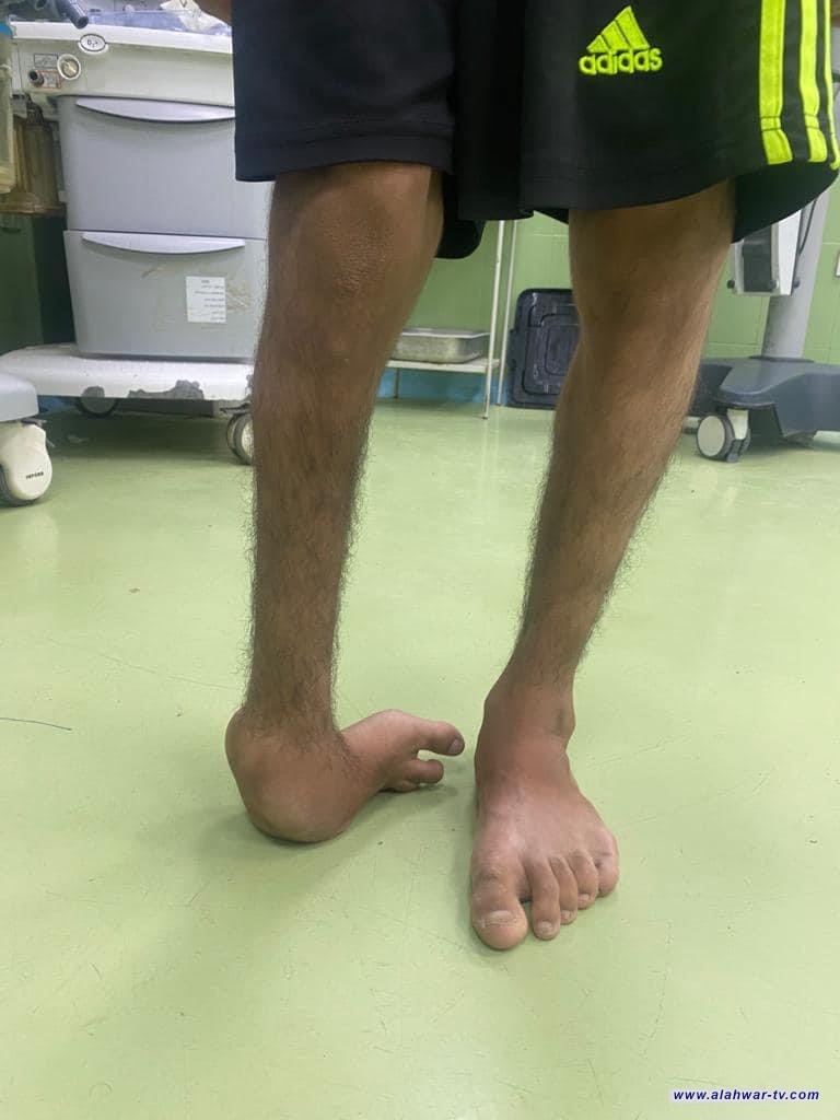 مستشفى الرفاعي العام يجري عملية نوعية لمريض يعاني من حالة حنف القدم المهمل