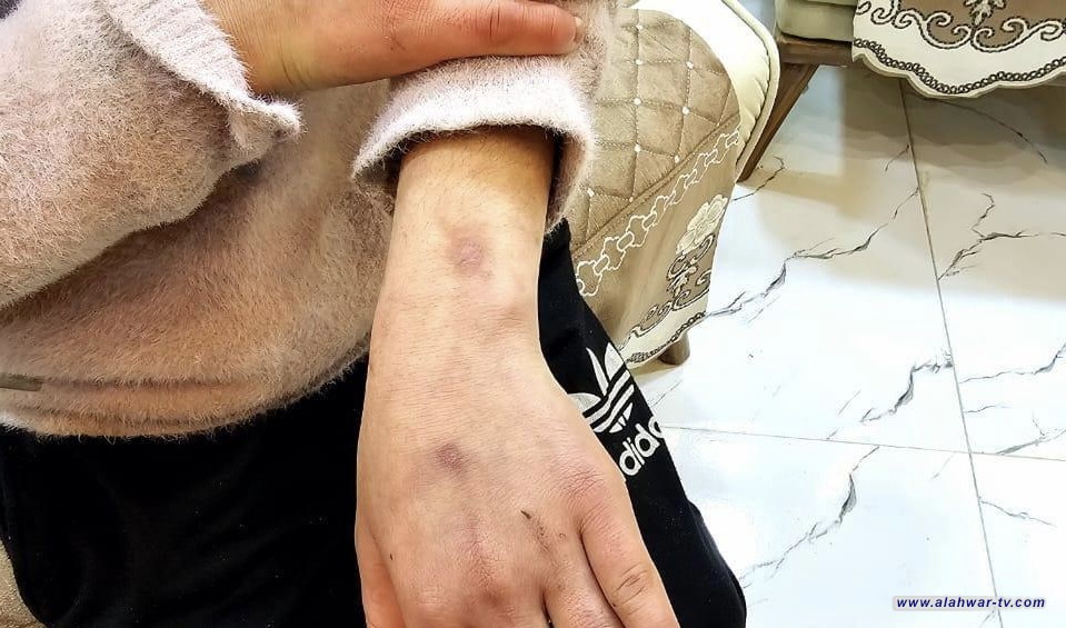 القبض على أب عذب ابنته بالحرق ب آلة حادة