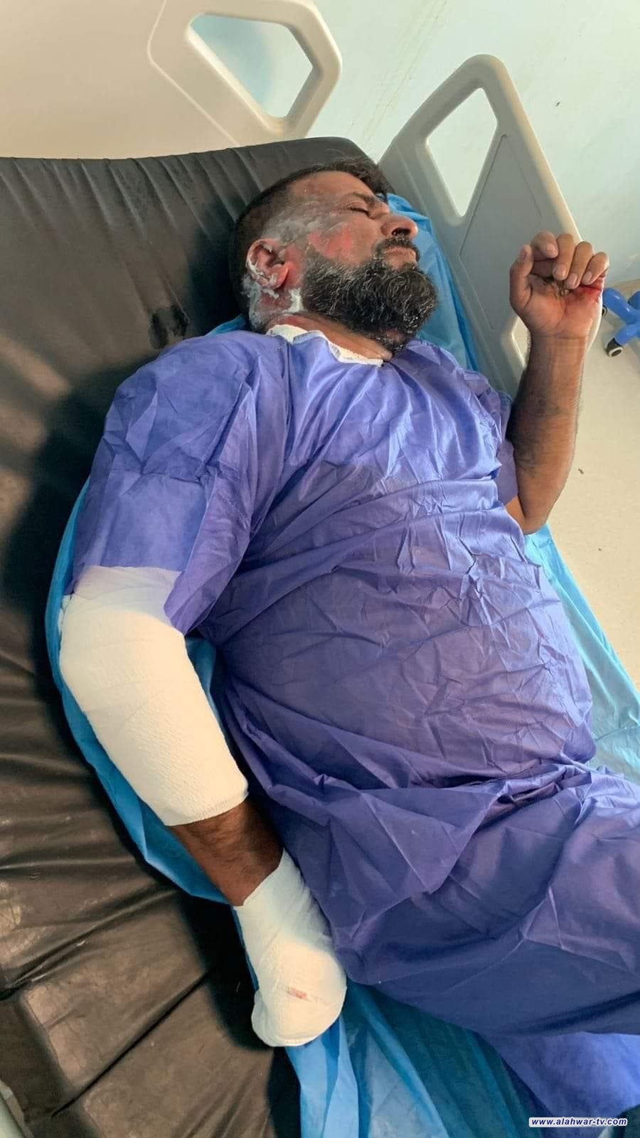 اصابة موظف بحروق في كهرباء ناحية الفضلية أثناء أداء الواجب في صيانة الشبكة الكهربائية