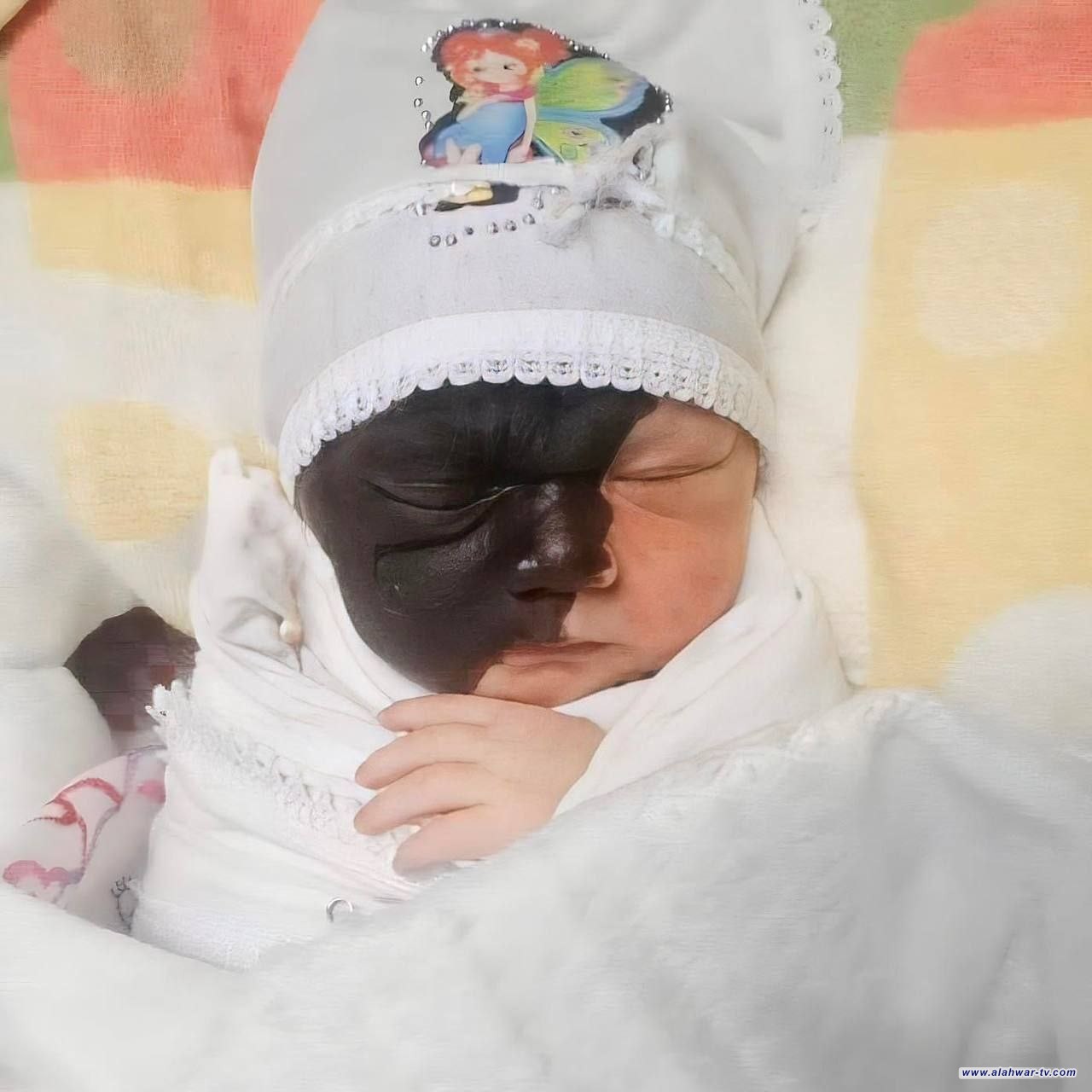 حالة نادرة من الولادة تصيب طفل من كركوك
