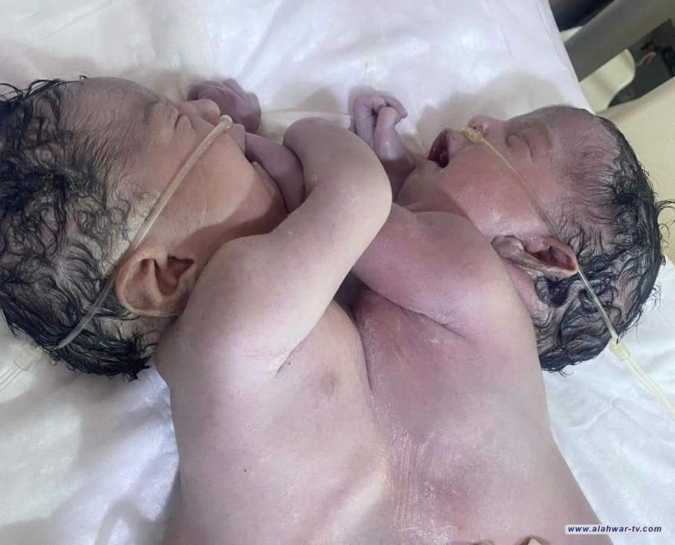 مستشفى في واسط يسجل ولادة "توأم سيامي" ملتصق في منطقة البطن والام والتوأم بصحة جيدة
