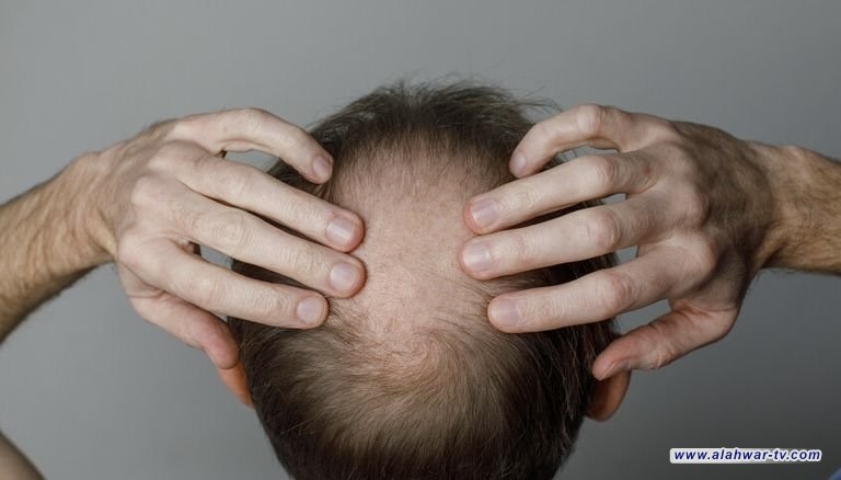 دواء جديد لمعالجة الصلع الوراثي لدى الرجال