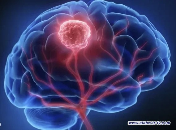 أعراض ورم الدماغ