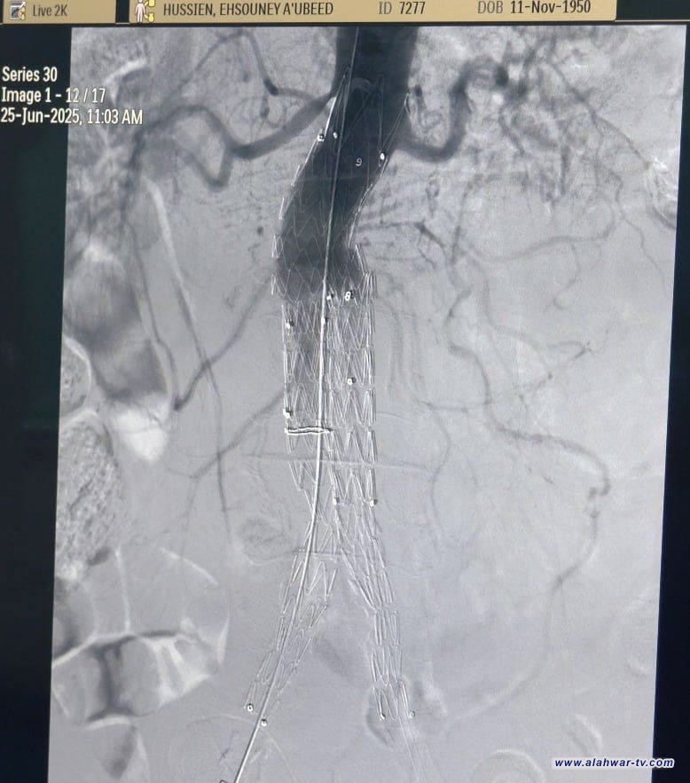مستشفى الناصرية للقلب ينجح في أول عملية نوعية لإصلاح الشريان الأورطي دون تخدير عام