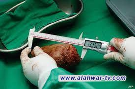 إزالة أكبر وأثقل حصوة كلوية في العالم وتدخل موسوعة غينيس